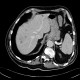 Abscess in liver, cholangoitis, maturation, second CT: CT - Computed tomography